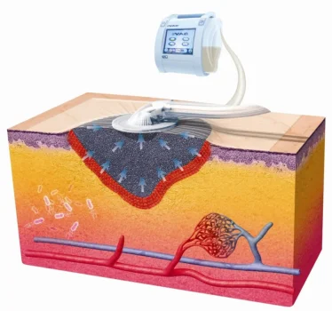 Vacuum-Assisted-Closure-VACR-The-figure-shows-the-foam-dressing-fitted-into-the